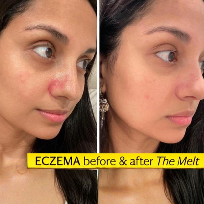 Unretouched before and after images of a LXMI customer with eczema, after using the Pure Nilotica Melt barrier balm
