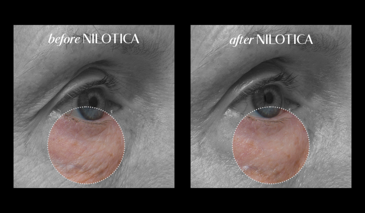 See instant results with LXMI Pure Nilotica Melt